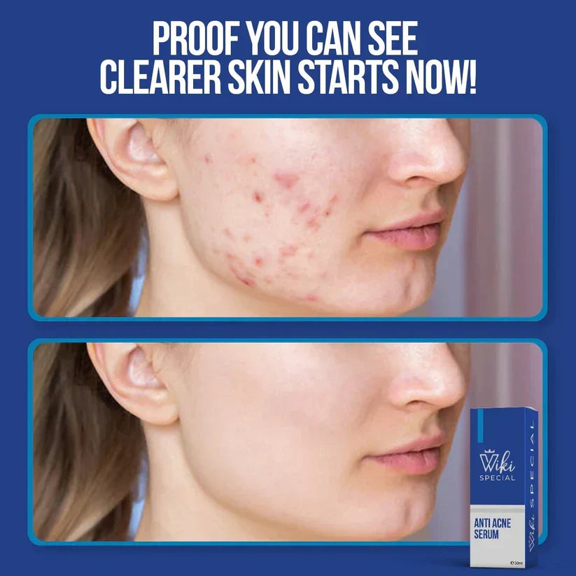 Wiki Special Anti Acne Serum